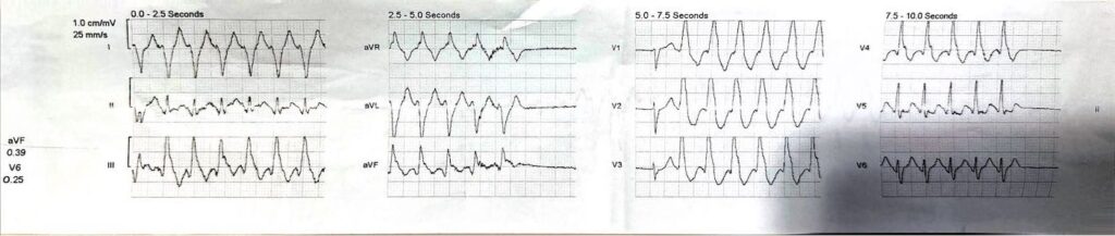 ECG - EMCORE